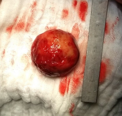 Fig. 2. – The thrombus outside of the left atrium.
