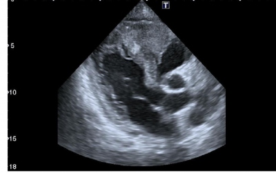 Obr. 2  Echokardiografie  modifikovan parasternln projekce na dlouhou osu (PLAX), tumor