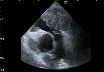 Obr. 3  Echokardiografie  parasternln projekce na krtkou osu (PSAX), vtokov trakt prav komory (RVOT), tumor