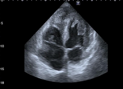 Obr. 4  Echokardiografie  apikln tydutinov projekce (A4C), tumor 