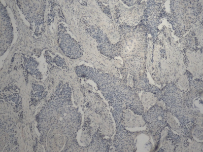Obr. 7  Imunohistochemie  cytokeratin 7 (CK7)