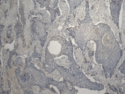Obr. 8  Imunohistochemie  cytokeratin 20 (CK20)