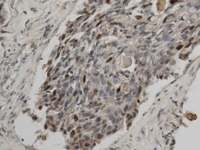 Obr. 9  Imunohistochemie  jadern protein regulujc bunn cyklus p53 (P53) slab pozitivn
