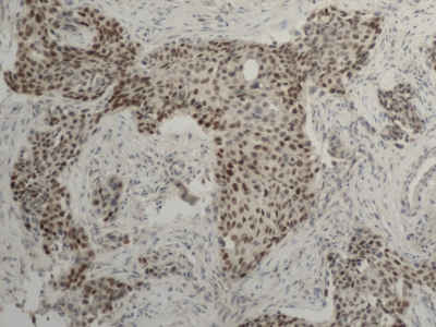 Obr. 10  Imunohistochemie  jadern protein bazlnch bunk rznch typ epitelu p40 (P40) pozitivn