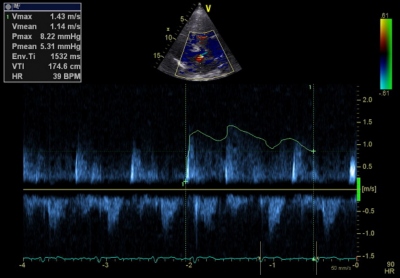 Obr. 1 – Echokardiografie, pulsní dopplerovská analýza průtoku na přepážce v levé síni, vrcholový gradient na membráně v levé síni odpovídá hemodynamicky středně významné mitrální stenóze, 32. týden těhotenství.