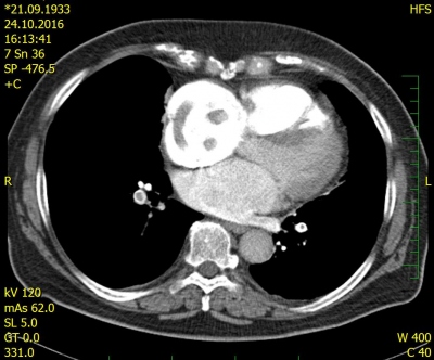 Obr. 1 – CT angiografie plicnice, diagnostika pomocí přímé vizualizace embolu zobrazené jako defekty kontrastní náplně lumen
