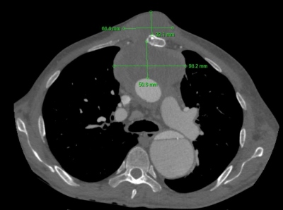 Obr. 2  CT hrudnku 