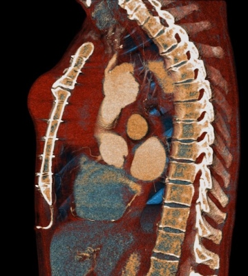 Obr. 3  CT nlez . 2