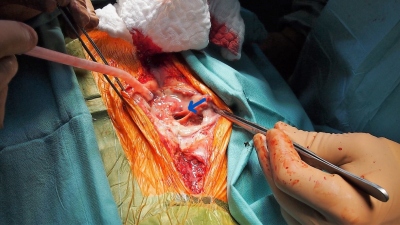 Obr. 4  Perioperan nlez  ipka oznauje msto komunikace abscesov dutiny.