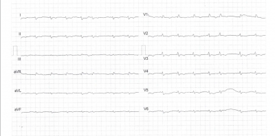 Obr. 5b  Srovnn EKG v vodu zdravotnch obt (kivka A) a pi diagnze CP (kivka B). Vidme nespecifick zmny jako snenou volt komplex QRS a oplotn a inverzi vln T.