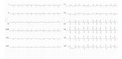 Obr. 5a  Srovnn EKG v vodu zdravotnch obt (kivka A) a pi diagnze CP (kivka B). Vidme nespecifick zmny jako snenou volt komplex QRS a oplotn a inverzi vln T.