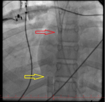 Obr. 9  Skiaskopie  sprvn poloha kanyl ECMO v prav sni, erven ipka  17F kanyla z vena jugularis l. dx, lut ipka  20F kanyla z vena femoralis l. dx