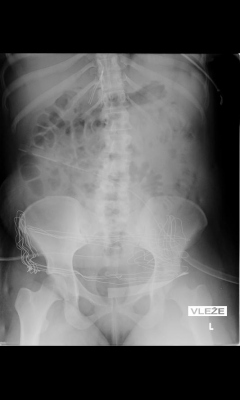 Obr. 2 – Rtg snímek znázorňuje anatomickou pozici kaválního filtru umístěného suprarenálně.  