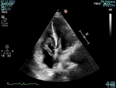 Obr. 5  Transtorakln echokardiografie  tranzientn embolus v PFO o celkov velkosti 10,1  1 cm, v prav sni o velikosti 6  1 cm. Je mobiln a propadv pes st trikuspidln chlopn do prav komory. 