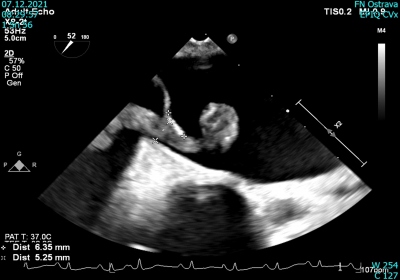 Obr. 4  Transezofageln echokardiografie. Embolus pesahujc z prav do lev sn pes foramen ovale.  