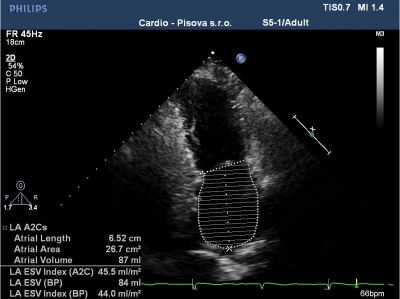 (D) dvoudutinov projekce pi men objemu lev sn  LA ESV (left atrium endsystolic volume). 