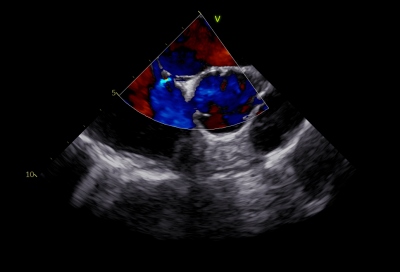 Obr. 1  Prkaz PFO pi jcnov echokardiografii. PFO  perzistentn foramen ovale.