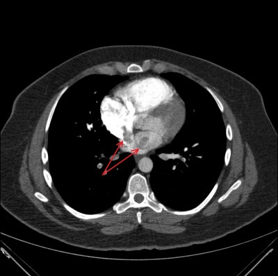 Fig. 2  CT angiography of heart chambers with suspected thrombus in the right atrium.