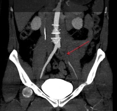 Fig. 3  CT angiography of arteries of lower extremities with occlusion of the left femoral artery.