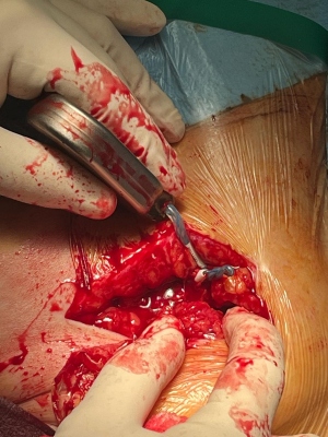 Obr. 3 � Otev�en� kapsa ICD. Potvrzen twiddler syndrom.