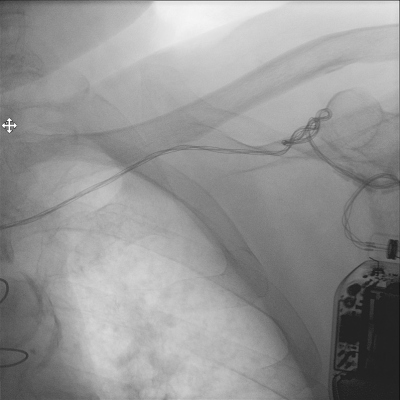 Obr. 2 � Skiaskopie p�i revizi ICD. Je patrn� sto�en� elektrody p�ed vstupem do �iln�ho syst�mu.