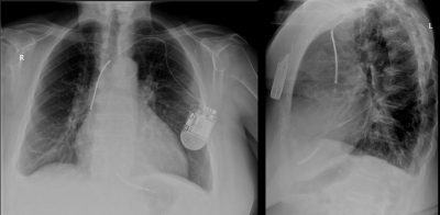 Obr. 1 � Rentgenov� sn�mek po primoimplantaci ICD. Defibrila�n� elektroda je ve zvykl� pozici v prav� srde�n� komo�e.